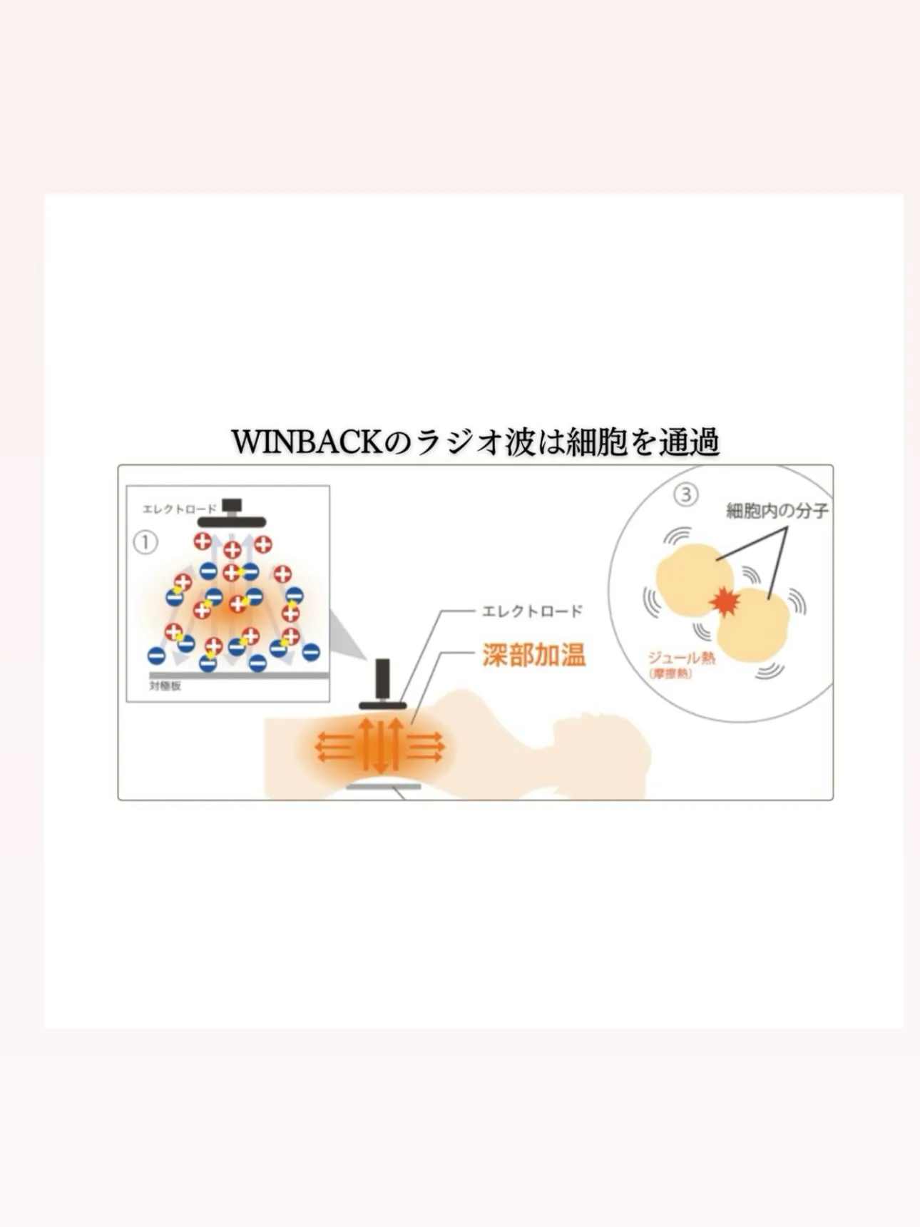 WINBACK 4はアメリカFDA承認を取得している高周波温...