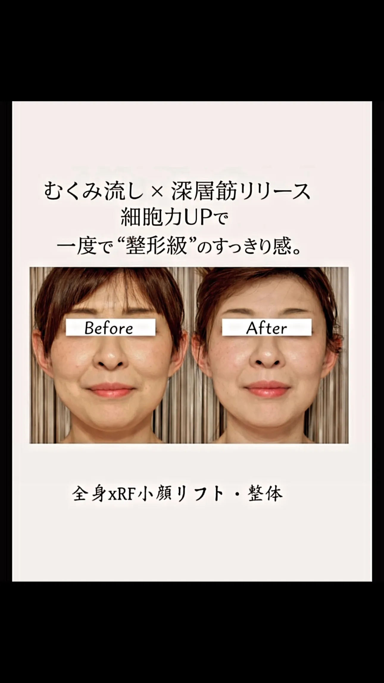 ✨施術前（肋骨の動き低下 × 肩の高さ·肩甲骨のバランス× ...
